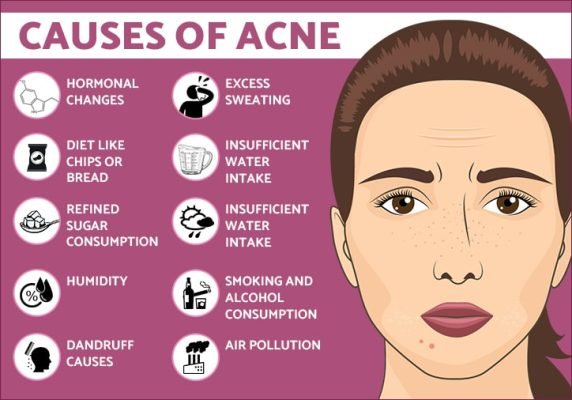 How to Avoid Breakouts | Effective Tips for Clear Skin