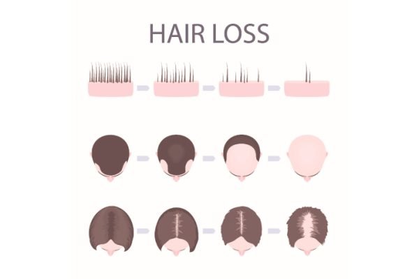 Does Minoxidil Work For Hair Loss | AjantaStore Expert Blog
