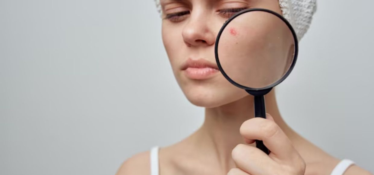 how to stay away from pimples