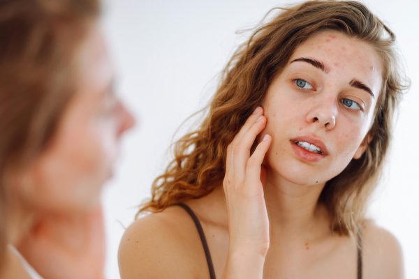 why am I breaking out